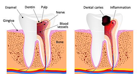 Illustration of a healthy tooth versus a tooth with decay