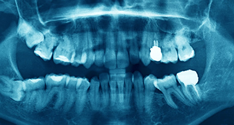 Dental X-ray illustrating Composite Restorations