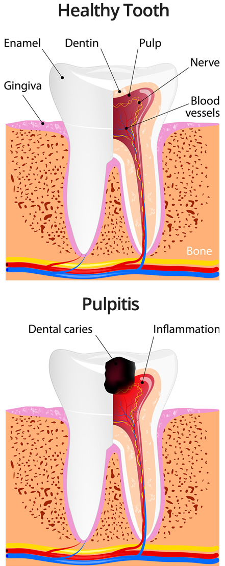 Illustration of a healthy tooth versus one that has Pulpitis