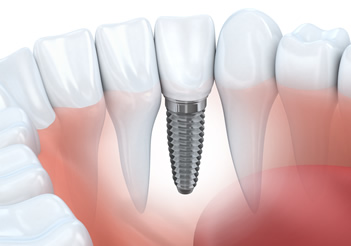 Dental Implants