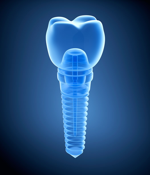 Illustration of the Root Canal process