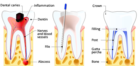 Illustration of the Root Canal process