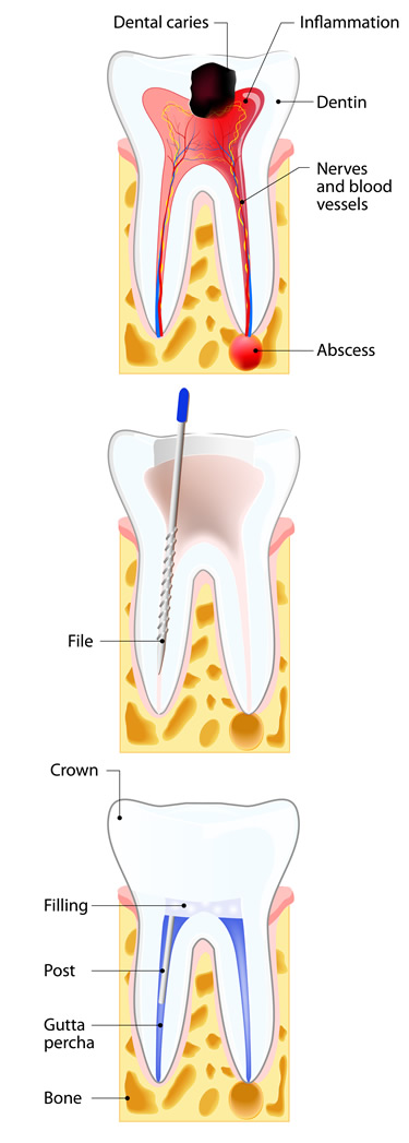 Illustration of the Root Canal process