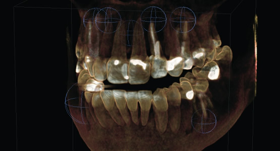 An example of a 3D image by Sirona technology